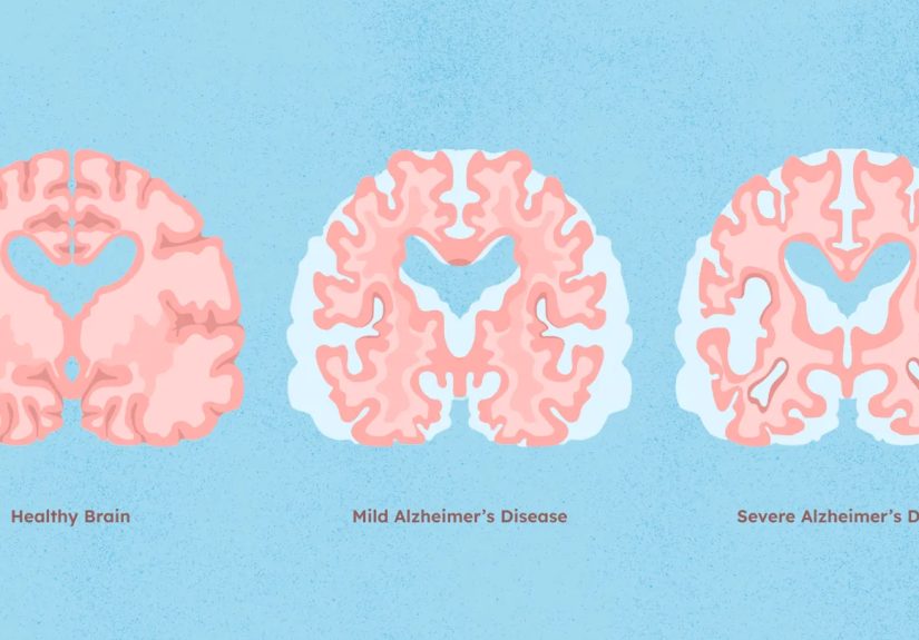 Alzheimer’s Disease Stages and How They Progress