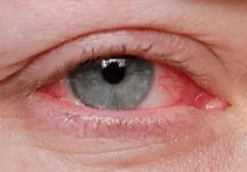 Do I have Pinkeye?