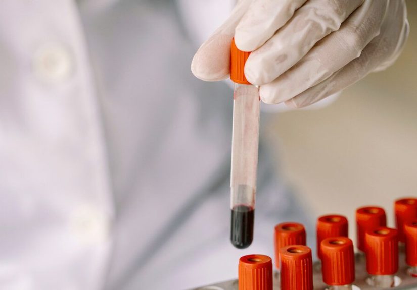 How Is Prostate Cancer Detected? About the PSA Test and More