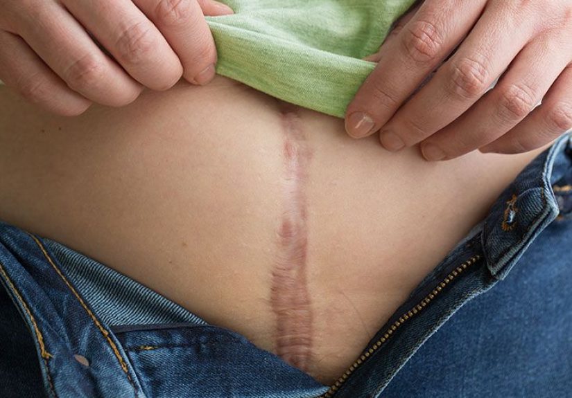 Hysterectomy side effects: Recovery and long term impact