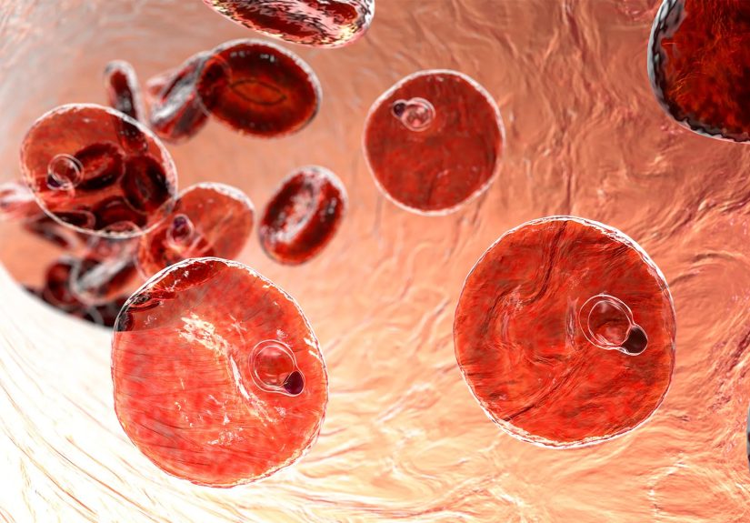 Malaria: Causes, Symptoms, and Treatment
