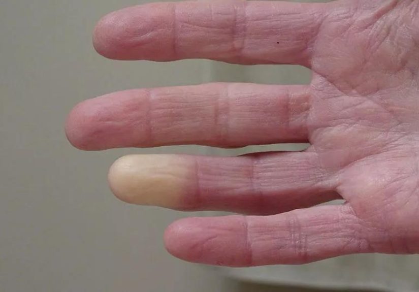 My Hands and Feet Are Always Cold  Should I Worry?