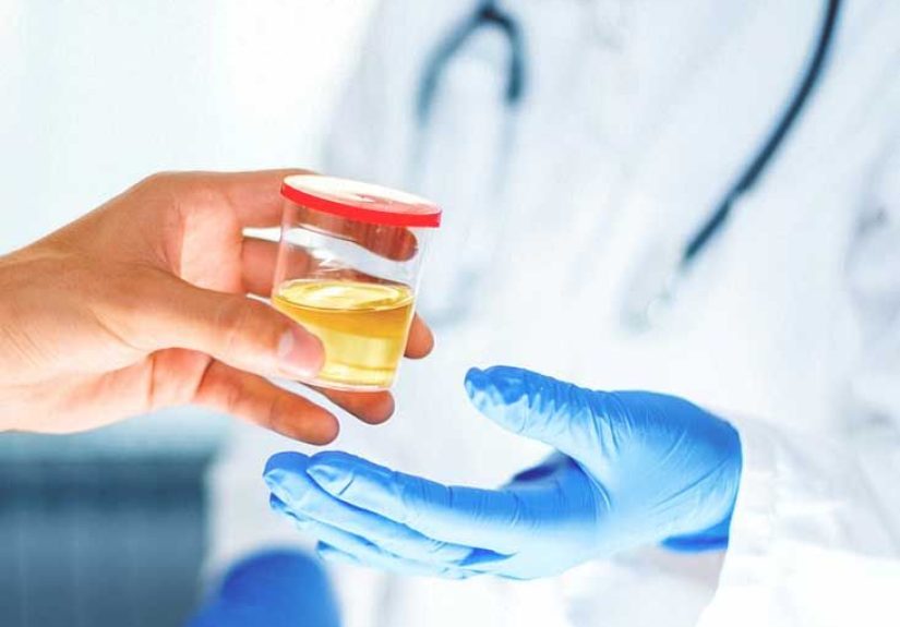 PCA3 Test and Prostate Cancer: What to Expect