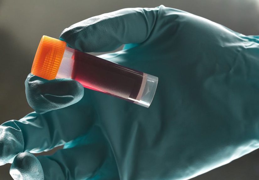 Triglyceride Level Test: Procedure, Preparation, and Risks