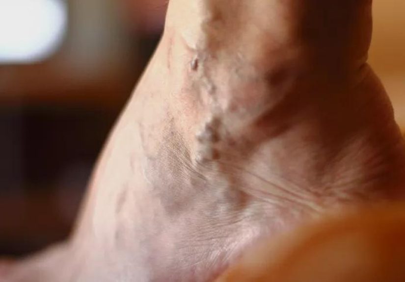 Varicose Veins: 7 Myths You Shouldn’t Believe