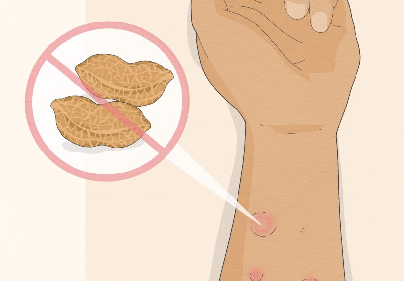 3 Ways to Read Allergy Skin Test Results