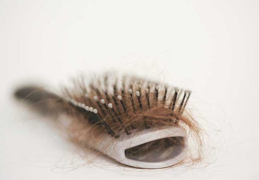 Alopecia Totalis: Causes, Symptoms, Treatment, Regrowth