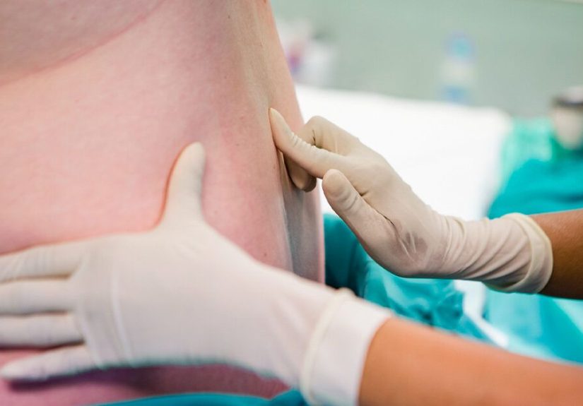Lumbar Epidural Steroid Injection: Your FAQs