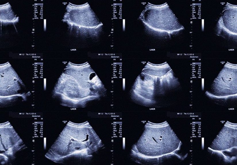 Understanding Fatty Liver Cancer