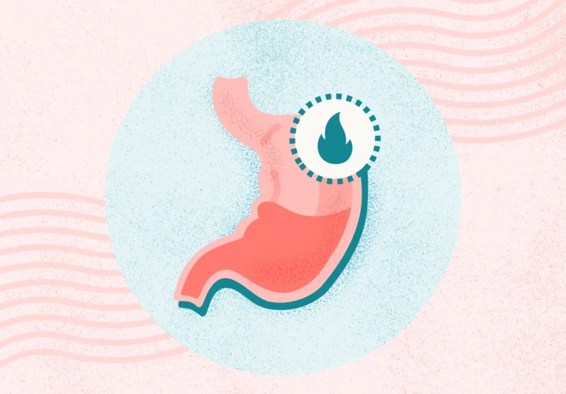 What Is GERD? Symptoms, Causes, Diagnosis, Treatment, and Prevention