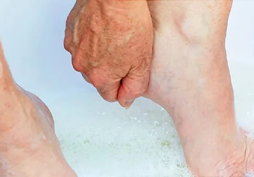 What Is Plantar Fasciitis?