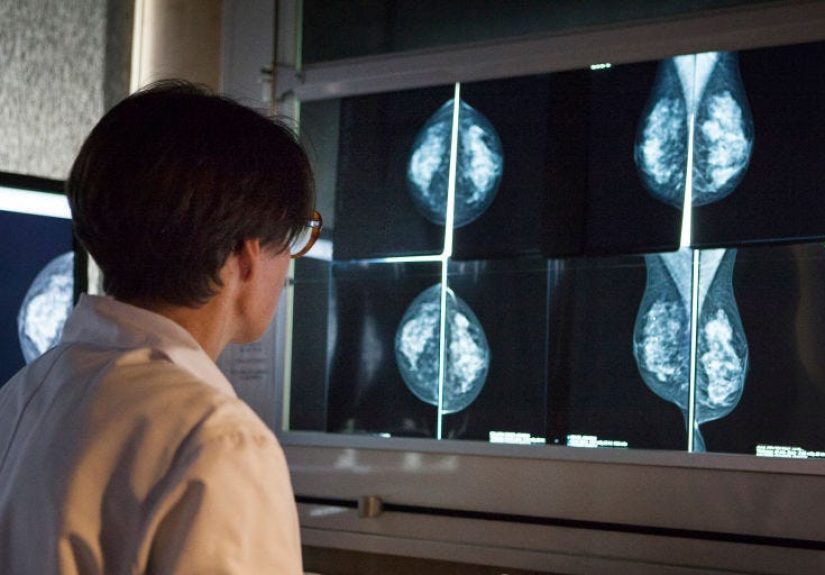 AI Diagnosing Cancer