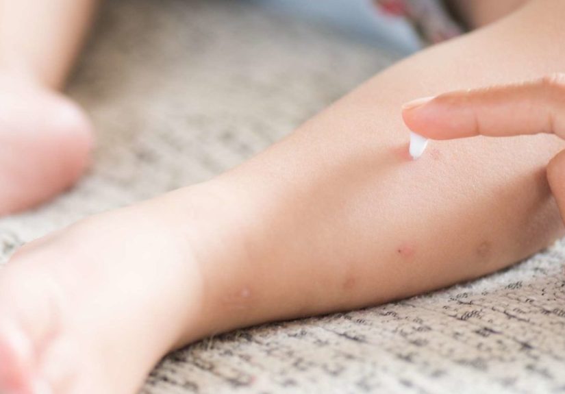 Chickenpox scar removal: Treatments and home remedies