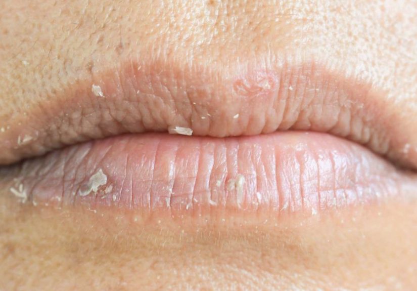 Eczema en los labios: Tipos, desencadenantes y tratamiento