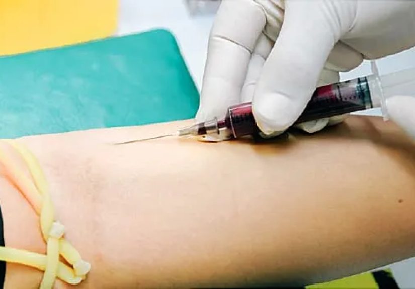 How Is Lupus Diagnosed?