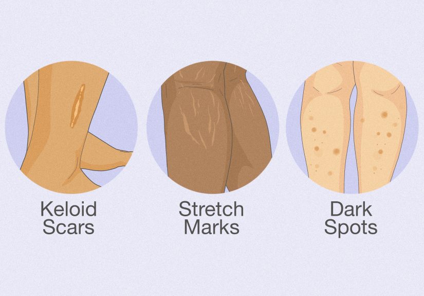 How to Remove Scars on Legs: Creams, Home Remedies, & More