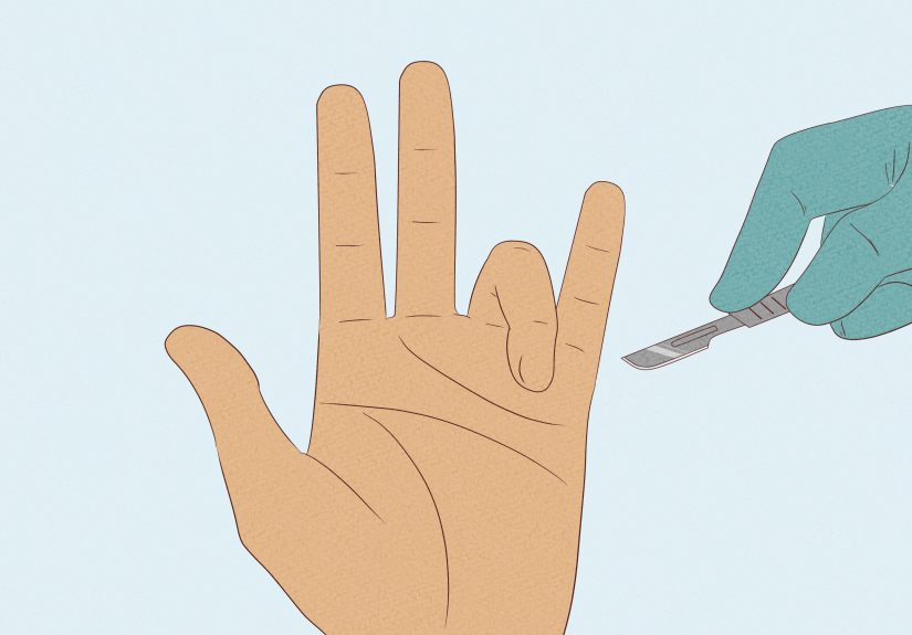 How to Treat Trigger Finger: 8 Steps