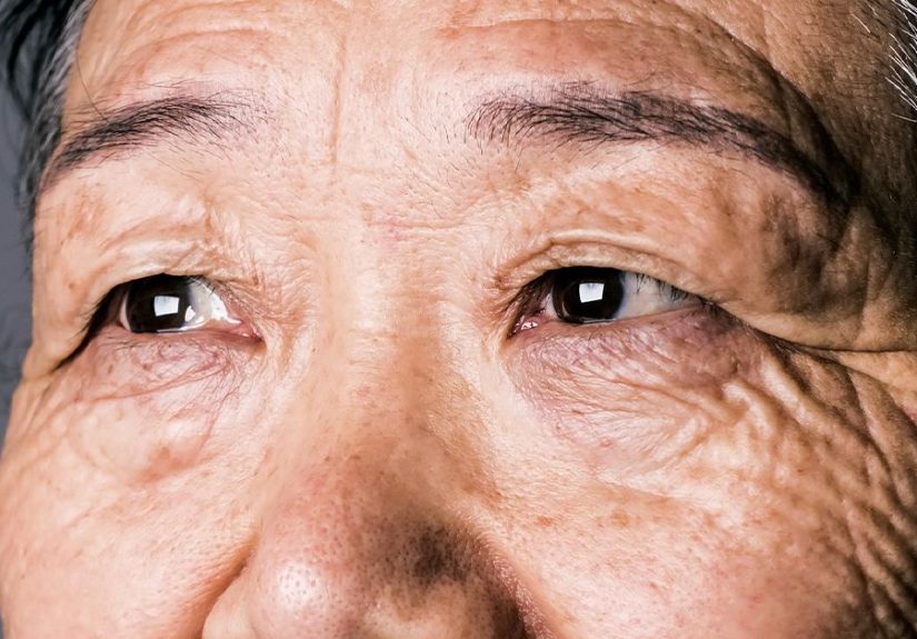 Macular Pucker vs. Macular Degeneration: Symptoms and More