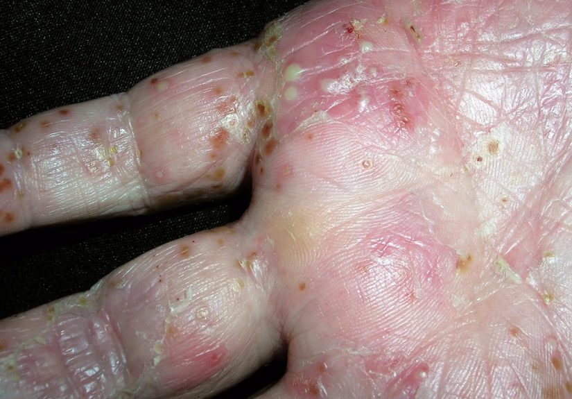 Palmoplantar Pustulosis on Hands and Feet: Symptoms, Causes, Treatment