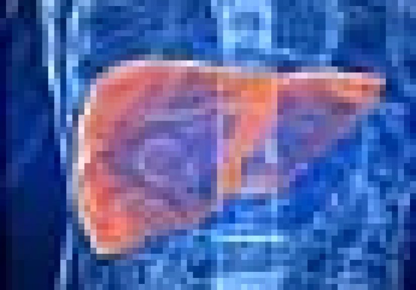 Primary Biliary Cholangitis: Symptoms, Causes, Diagnosis, Treatment