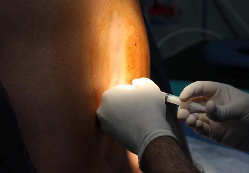 Spinal Block vs. Epidural: How They Differ