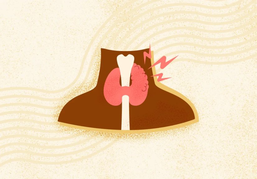 What Is Graves’ Disease? Symptoms, Causes, Diagnosis, and Treatment