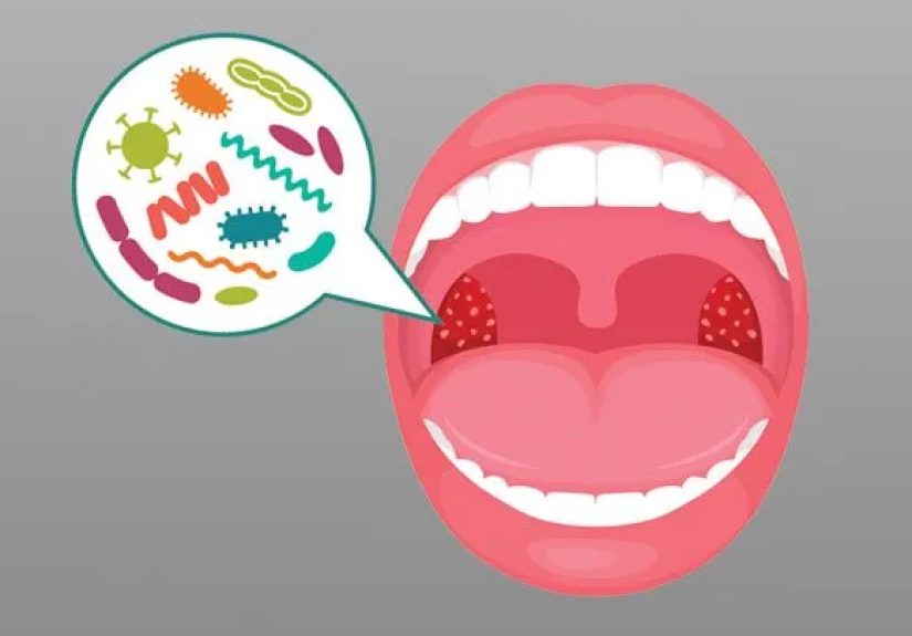 What Is Tonsillitis, and What Causes Tonsillitis?