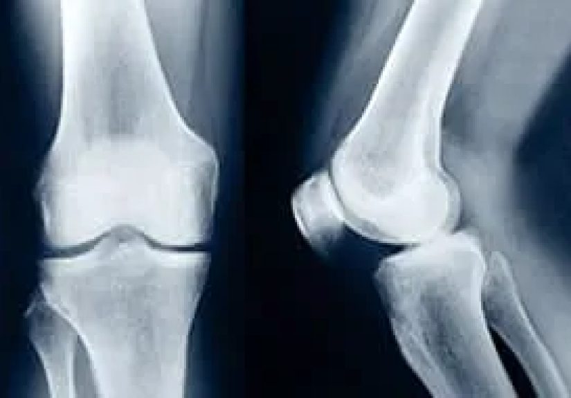 Bone Screenings After Fractures - Watch WebMD Video