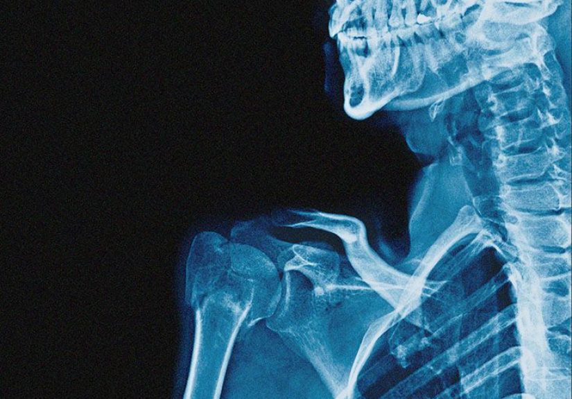 Causes of Psoriatic Arthritis: Triggers and Risk Factors