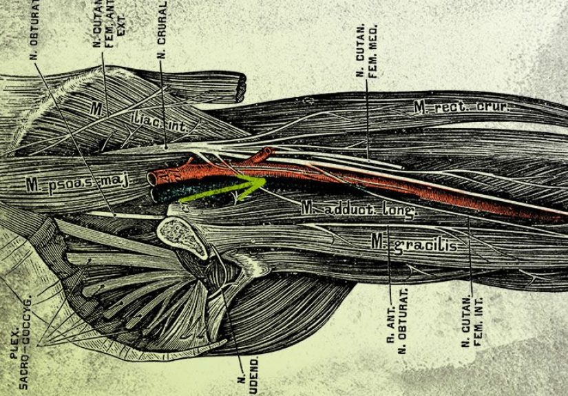 Femoral Neuropathy: Causes, Diagnosis, Treatment, and Exercises