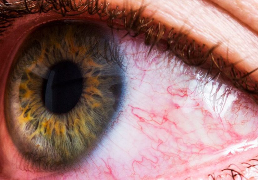 Lupus and Dry Eyes: Causes, Diagnosis, and Treatment