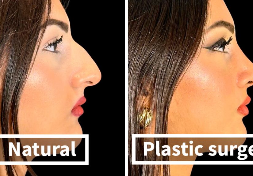 “Turning Back Time”: 50 People Who Became Completely Unrecognizable After Getting Cosmetic Surgery In Turkey